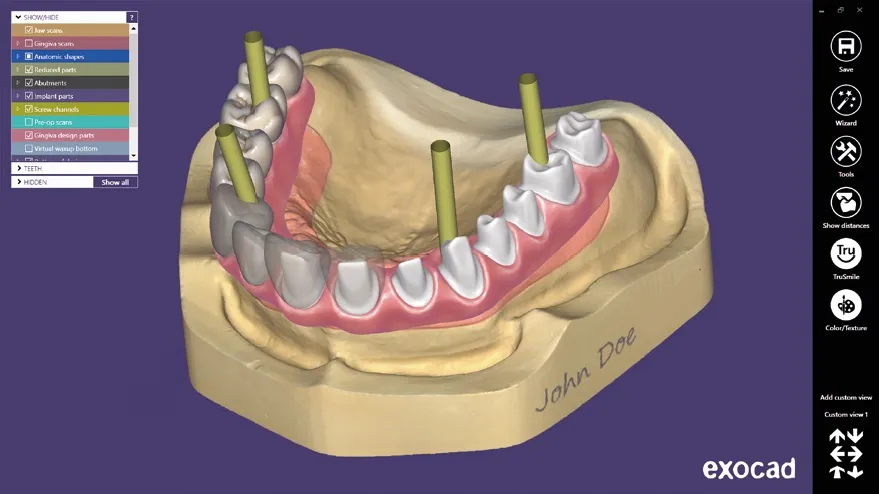 картинка Exocad Implant module - имплант модуль от магазина Udentis.ru